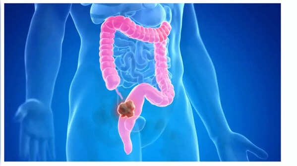 Sudden weight loss: When to suspect colon cancer