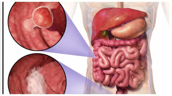 Detecting blood in stool: Why it's crucial not to ignore